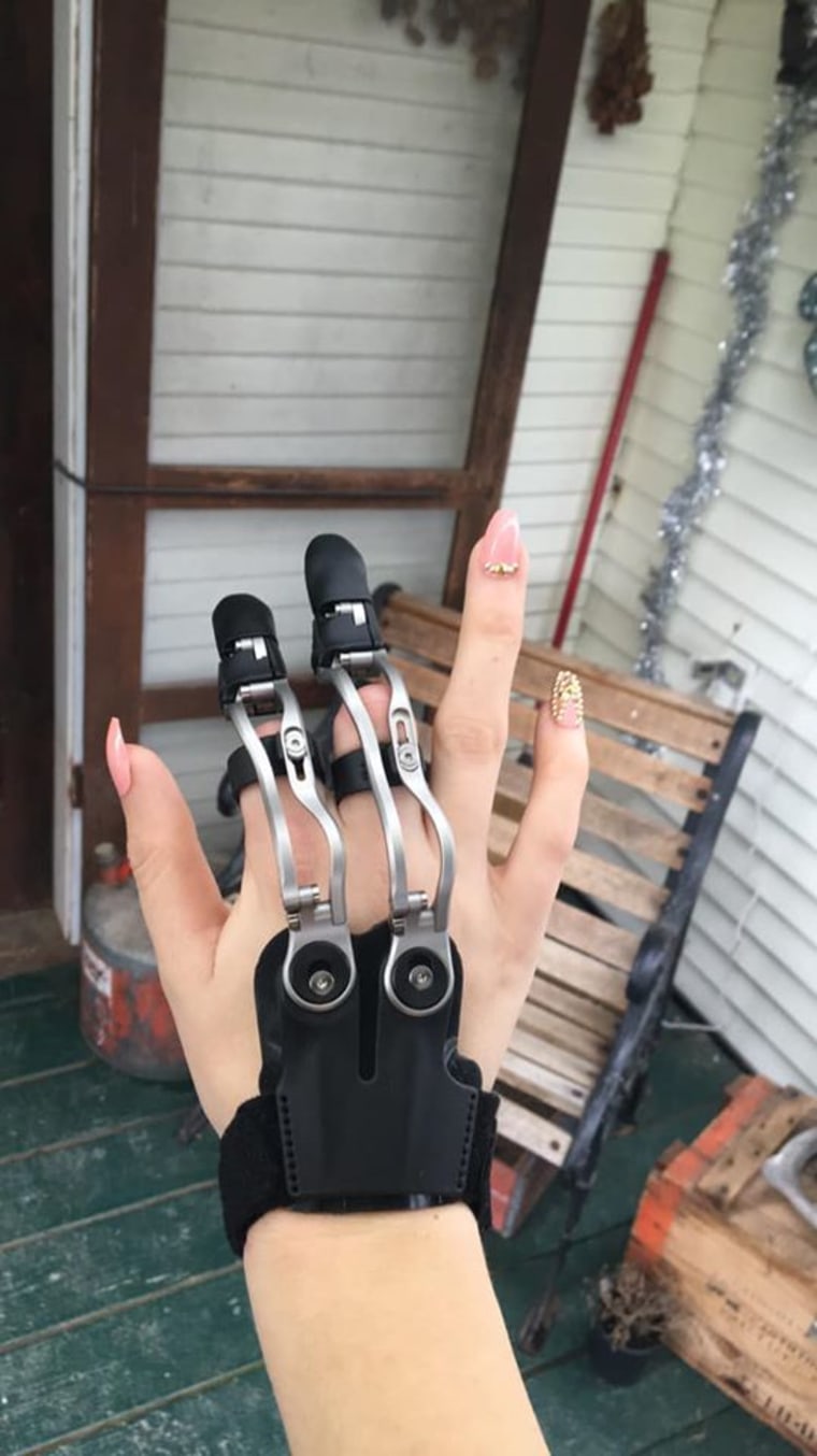 Woman who lost fingers in woodworking accident gets prosthesis