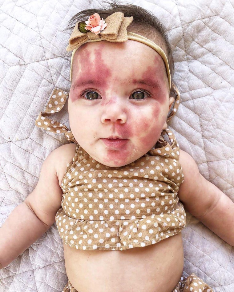 MUM OF BABY WITH PORT WINE STAIN HITS BACK AT BULLIES WHO CALLED HER DAUGHTER HIDEOUS AND A DEFECT - AND EVEN ASKED IF HER FACE HAD BEEN PUSHED ONTO A SKILLET