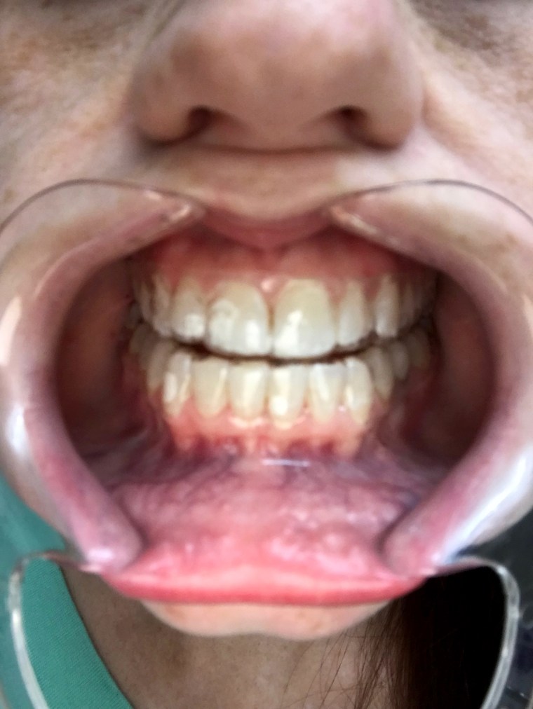 Imagem: Uma das várias fotos de sua boca que Rosemond submeteu ao SmiledirectClub, que dizia ser usada para monitorar seu tratamento