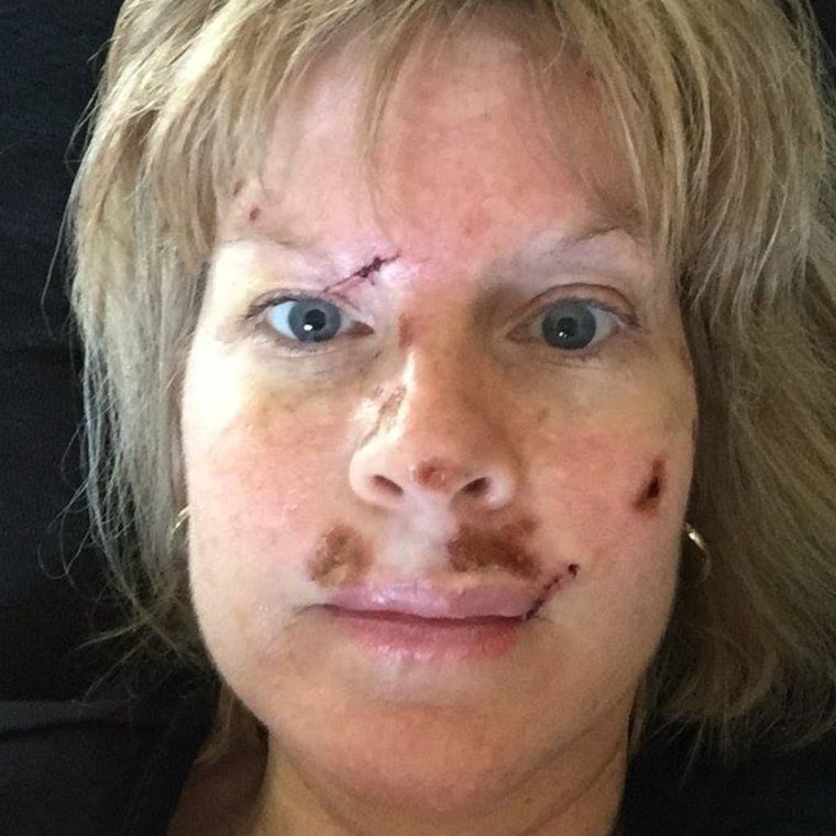 Judy Cloud has undergone several surgeries for skin cancer.