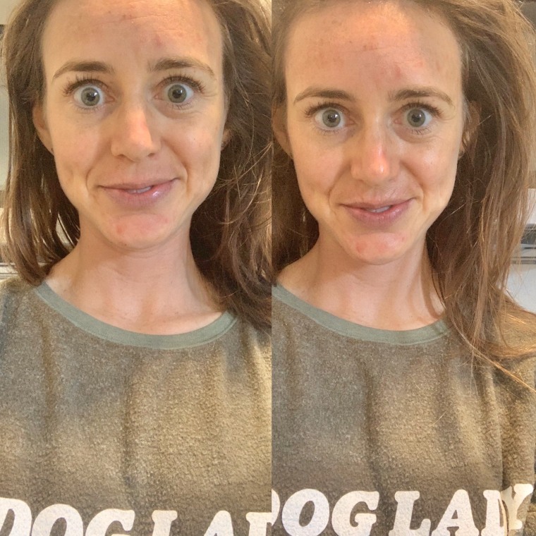 Before (left) and after (right) using the Kate Somerville ExfoliKate Intensive Pore Exfoliating Treatment