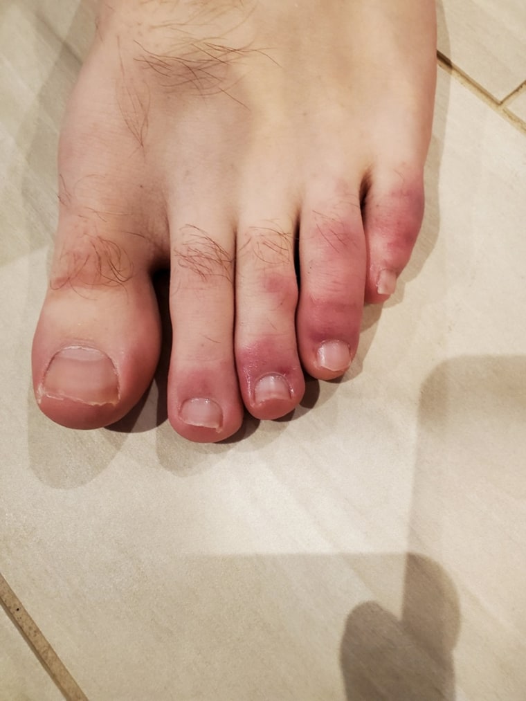 Dr. Tracey Vlahovic had a 30-year-old asymptomatic male patient with what appeared to be COVID toes because there's "seemingly no other reason for it," she said.