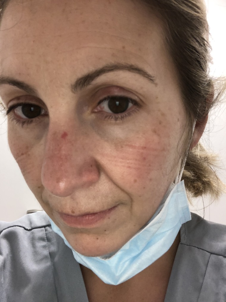 Houlihan wears two masks, a surgical one over an N95 to preserve it, for most of her shift, and she's developed bruises on her face. "I feel like I'm going to need a plastic surgeon after this," she joked.
