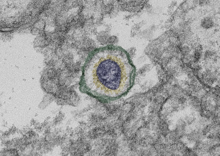 Transmission electron micrograph of a section of a Vero cell (grey) with SARS CoV-2 (blue capsid, yellow surface proteins, inside a vesicle (green.)