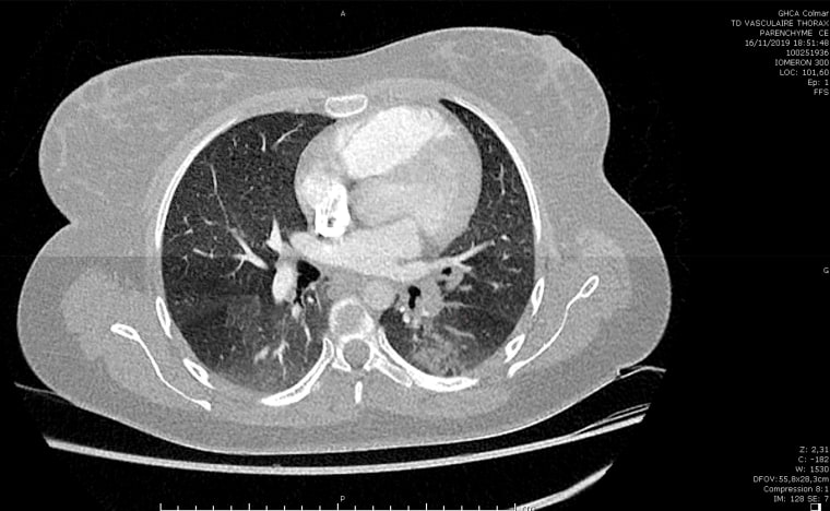 The scan of a suspected COVID-19 case under investigation by Dr. Michel Schmitt and his team. The first case can be traced back to November 16.