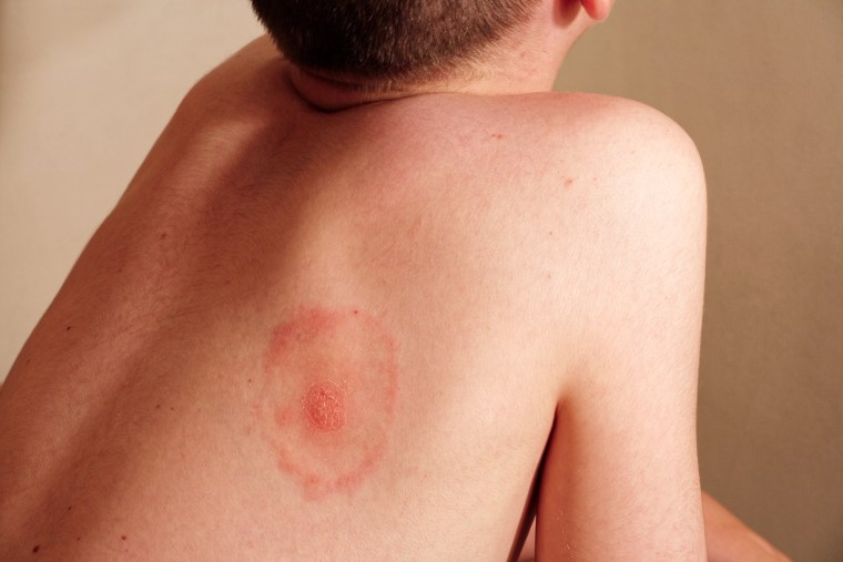 How Do You Get Ringworm? Symptoms, Causes, and Treatments