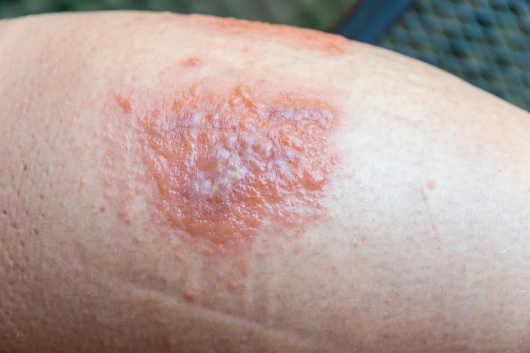 Poison Ivy rash and blisters on a leg