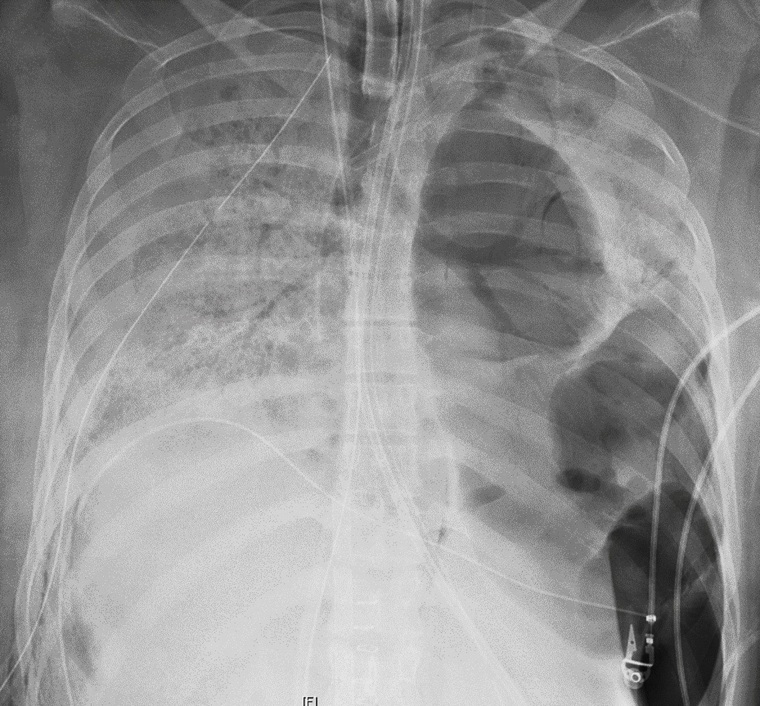 Image: The chest of a COVID-19 patient before she received a new set of lungs because of severe lung damage from the coronavirus, at Northwestern Memorial Hospital in Chicago.