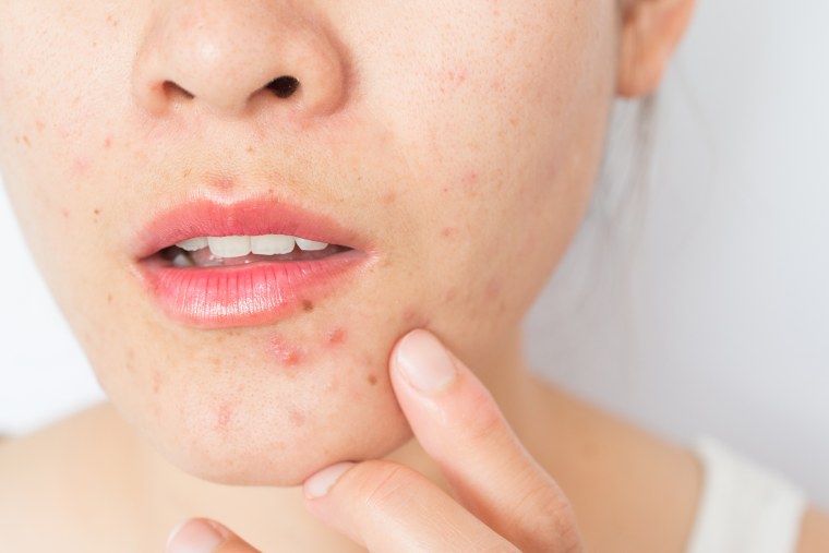 Skin conditions and photos of acne on a young white Caucasian woman