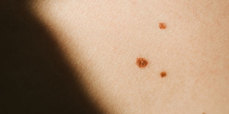 Closeup view shot of skin with birthmarks