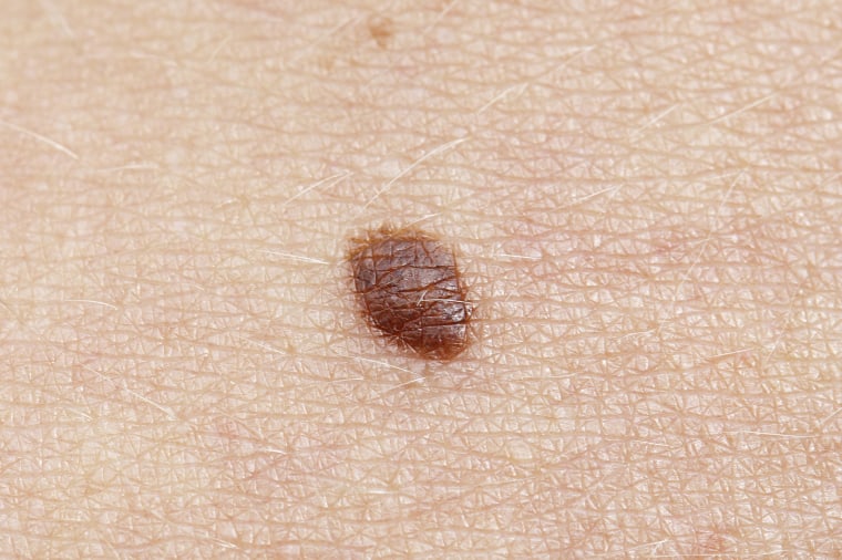 Skin conditions and photos of basal cell carcinoma