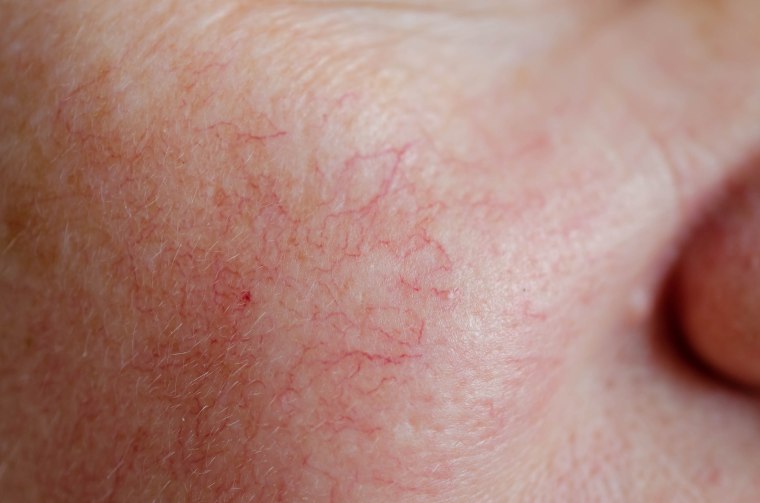 “Once you figure out the triggers and get a reasonable regimen, [rosacea] is pretty easy to control,” said Dr. McMichael.