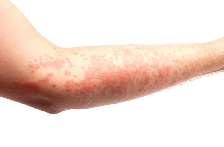 Photos of eczema skin condition and what causes eczema