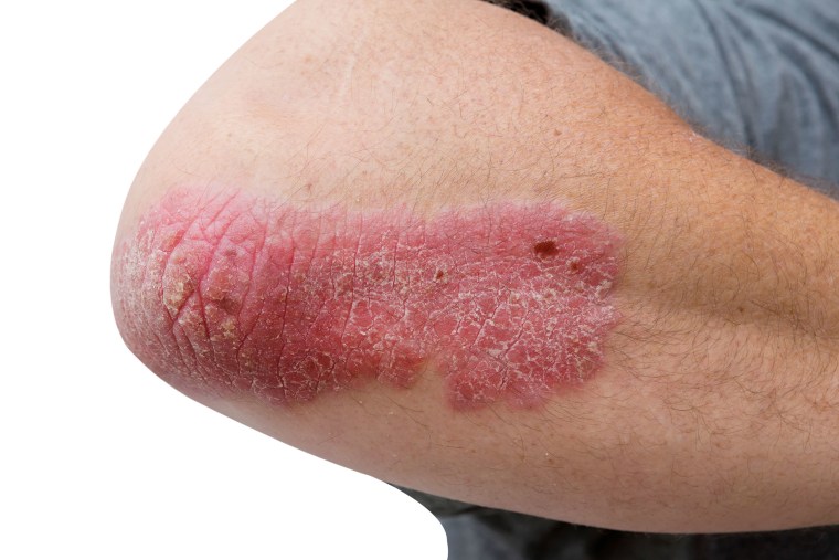 Biologic Therapy For Psoriasis Raleigh Nc