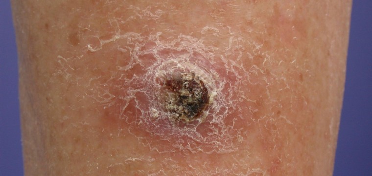 Squamous cell carcinoma pictures and about squamous cell carcinoma treatment