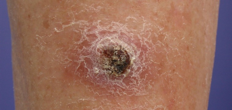 SQUAMOUS CELL CARCINOMA