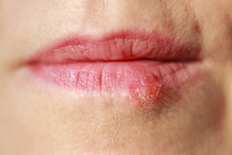 Causes of cold sores and how to treat cold sores and skin conditions