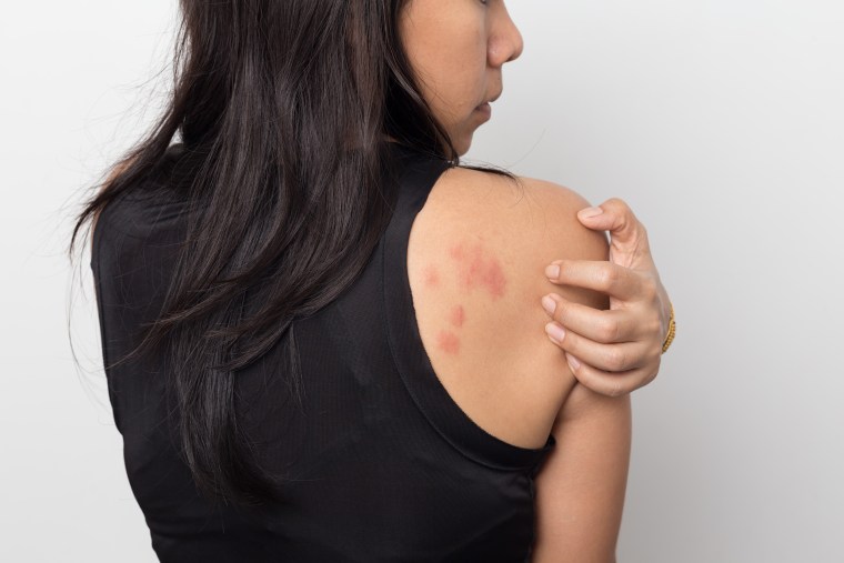 Photos of hives and what causes hives skin conditions