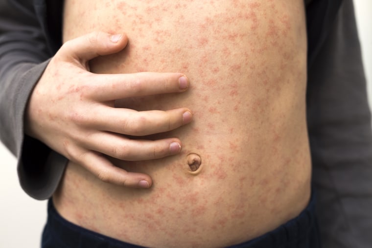 Sick child with red rash spots from measles.