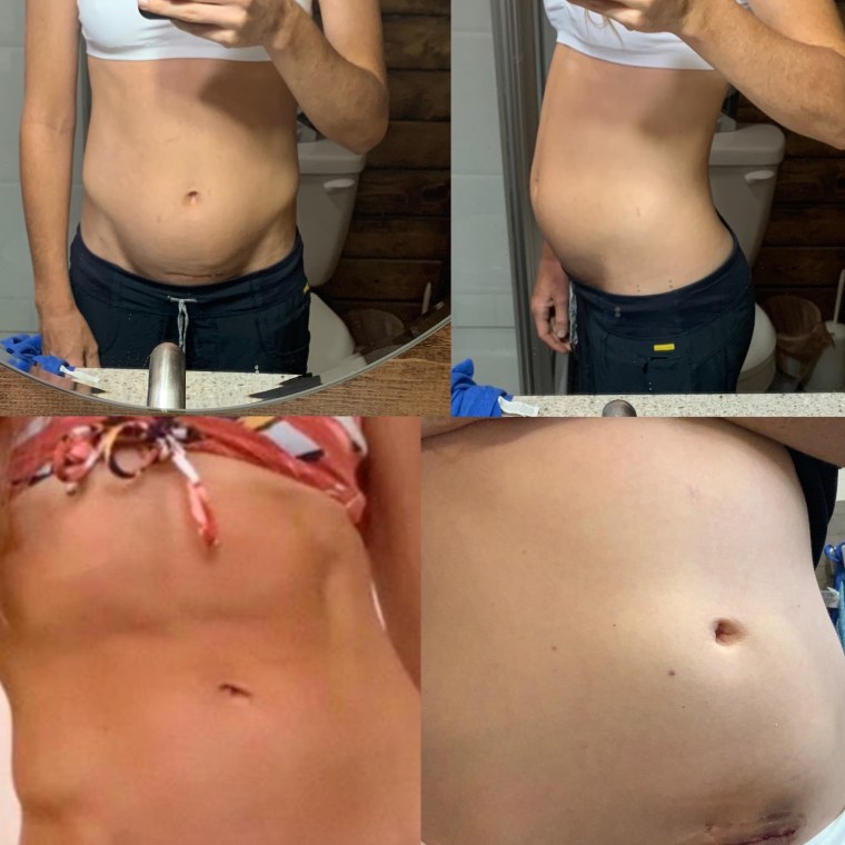 my belly before and after surgery