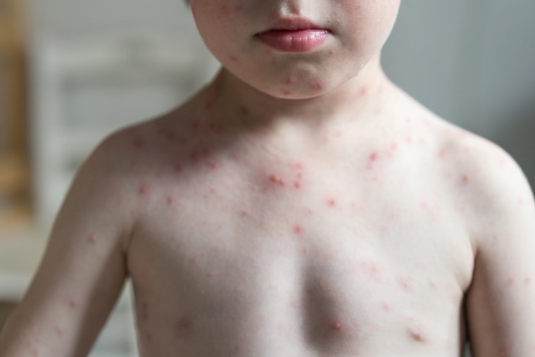 Child with varicella zoster virus and the skin condition chicken pox