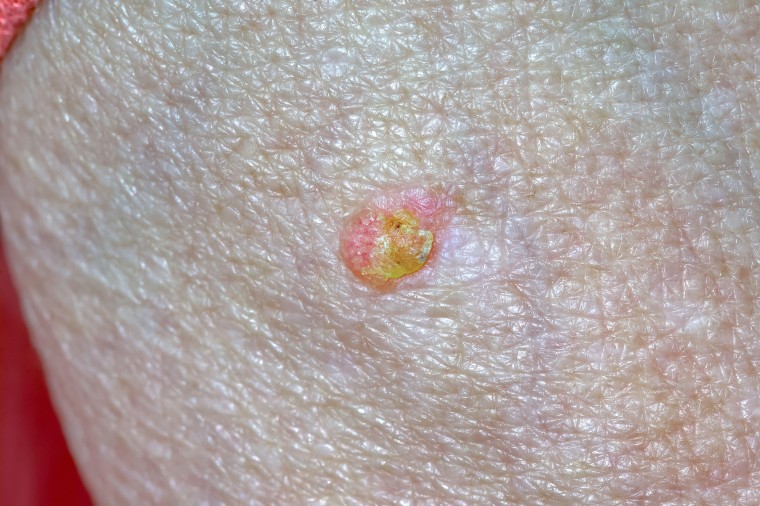 Photo of Actinic Keratosis