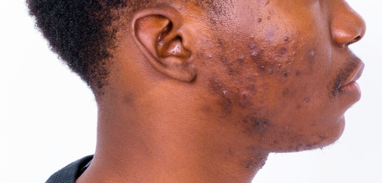 About skin conditions and photos of acne on black African American skin