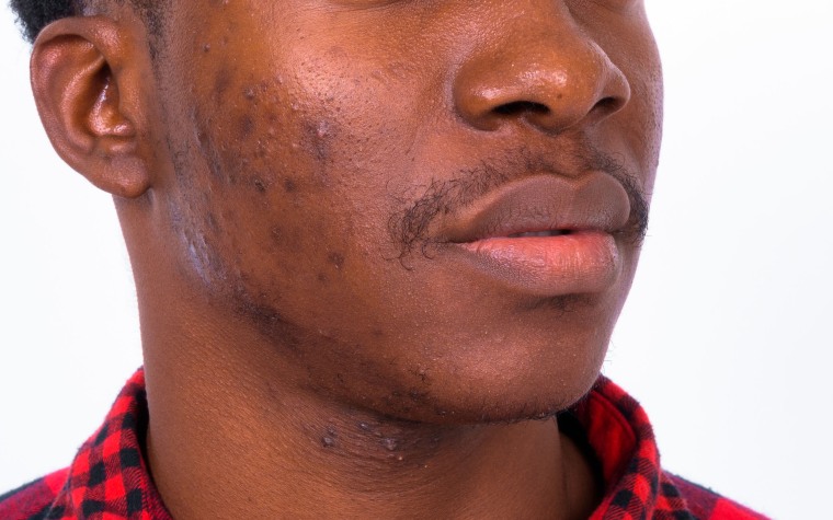 Acne is fairly universal in terms of how it looks, but there is more post-inflammatory hyperpigmentation (PIH) in darker skin, said McMichael. “The acne lesion may take 1 to 2 weeks to improve, but the PIH can last for many weeks to months.”
