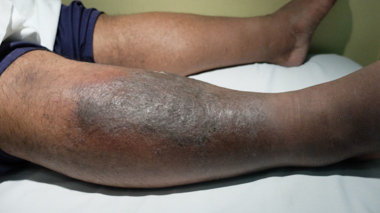 Cellulitis in the legs usually shows up on just one leg. “If you think you have it in both legs, chances are something else is going on,” said Dr. Laura Ferris.