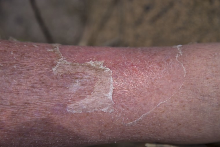 Photos of cellulitis and more about the skin condition cellulitis
