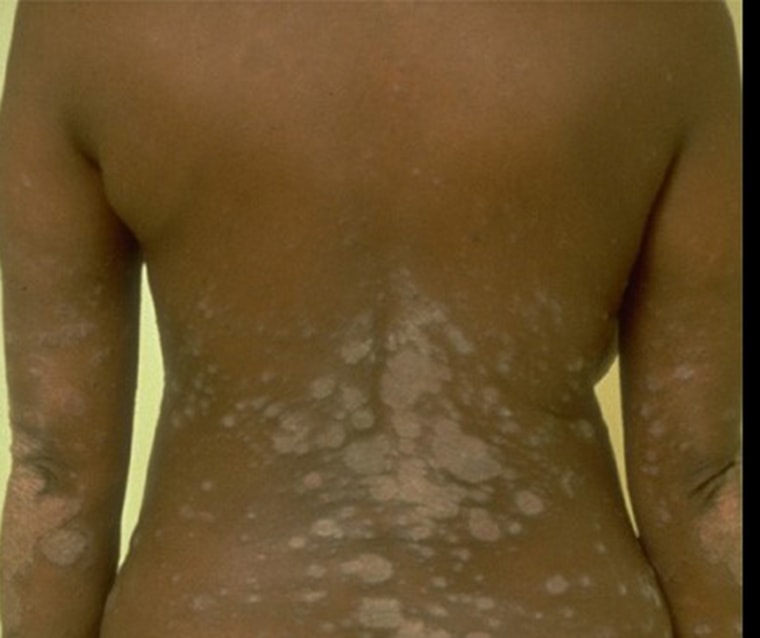 What psoriasis looks like on African American skin and how to treat psoriasis