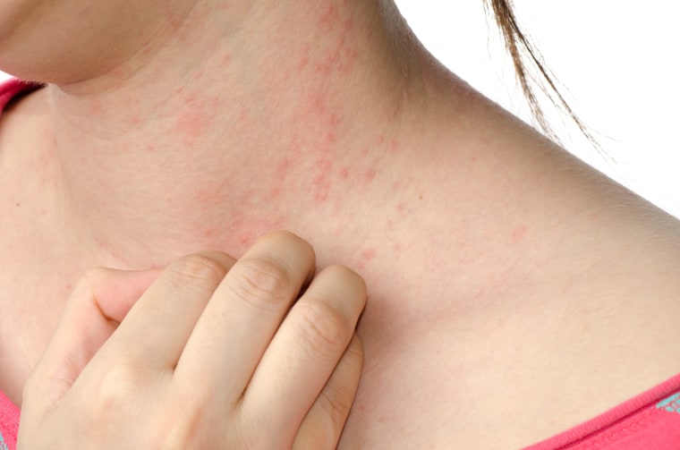 Health Problem, Skin Diseases. Young Woman Showing Her Itchy Back With Allergy  Rash Urticaria Symptoms Stock Photo, Picture and Royalty Free Image. Image  72326834.