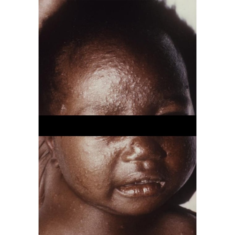 Photos of chicken pox skin condition on a black African American child