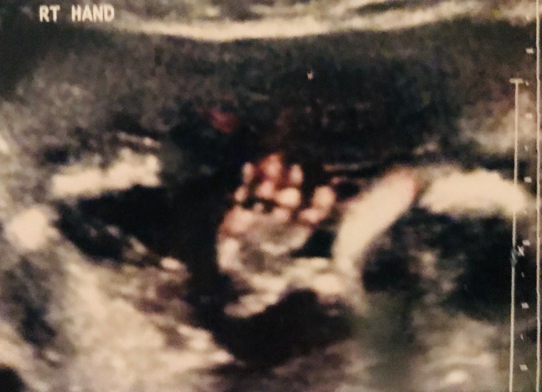 Jara's last ultrasound photo of baby Jessica, who received frequent monitoring in utero due to a lack of growth.