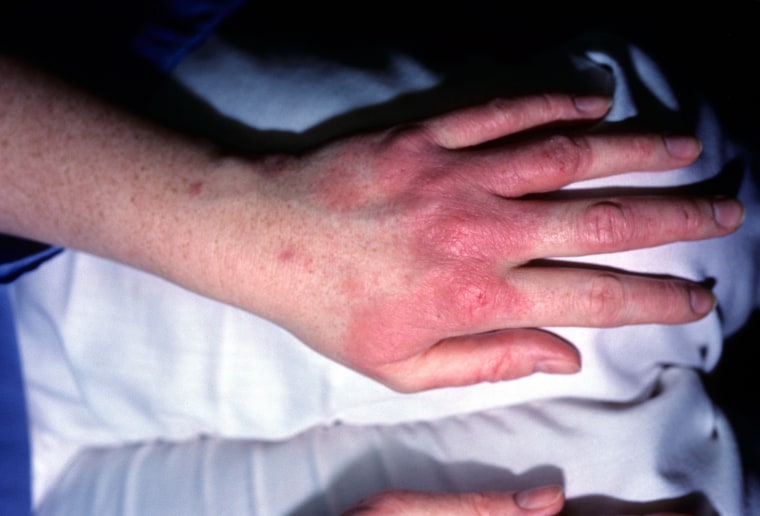 Contact dermatitis on hand. Eczematous.