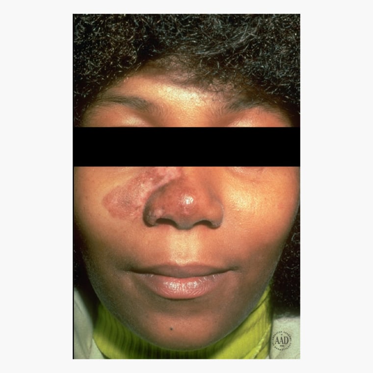 African American woman with lupus skin condition and how to treat lupus