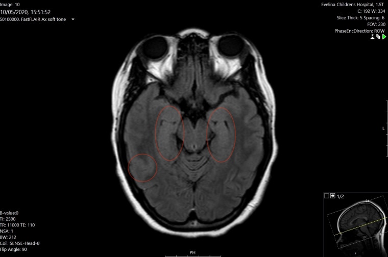 MRI scan