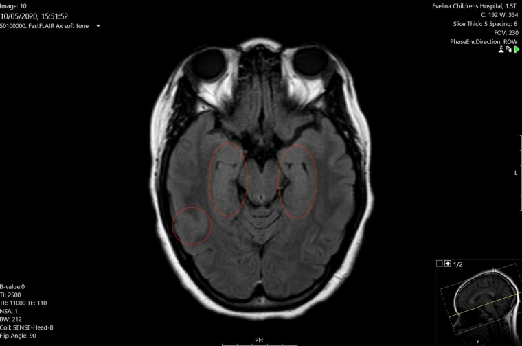 An MRI scan of Nia Haughton's brain, taken by doctors at a time when her neurological symptoms including hallucinations and seizures were at their most severe. Highlighted in red is the inflammation in specific parts of her brain that the neurological team treating her associated with COVID-19.