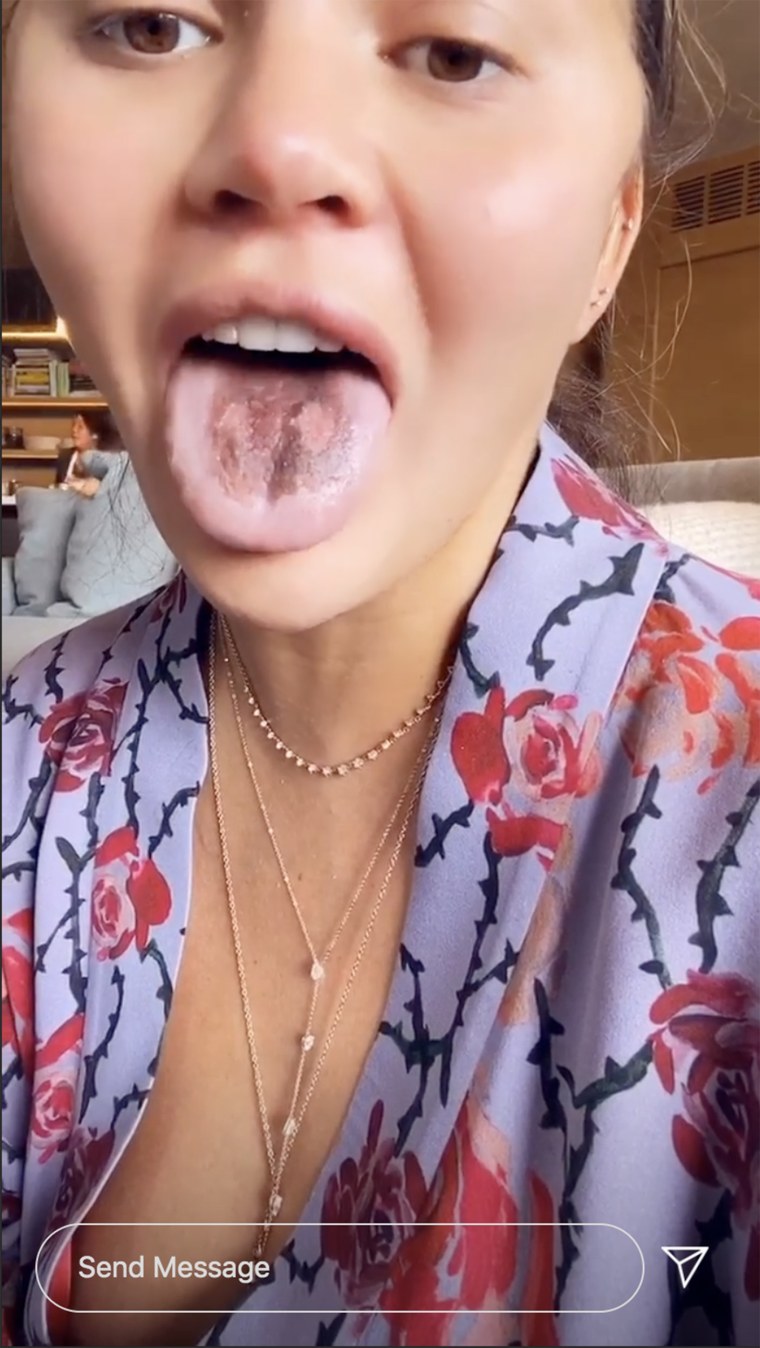 chrissy-teigen-s-tongue-is-peeling-after-eating-too-much-sour-candy