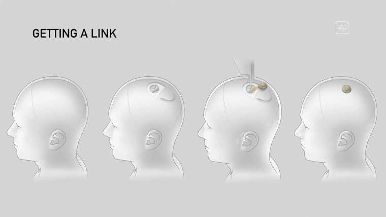 Image: A Neuralink device