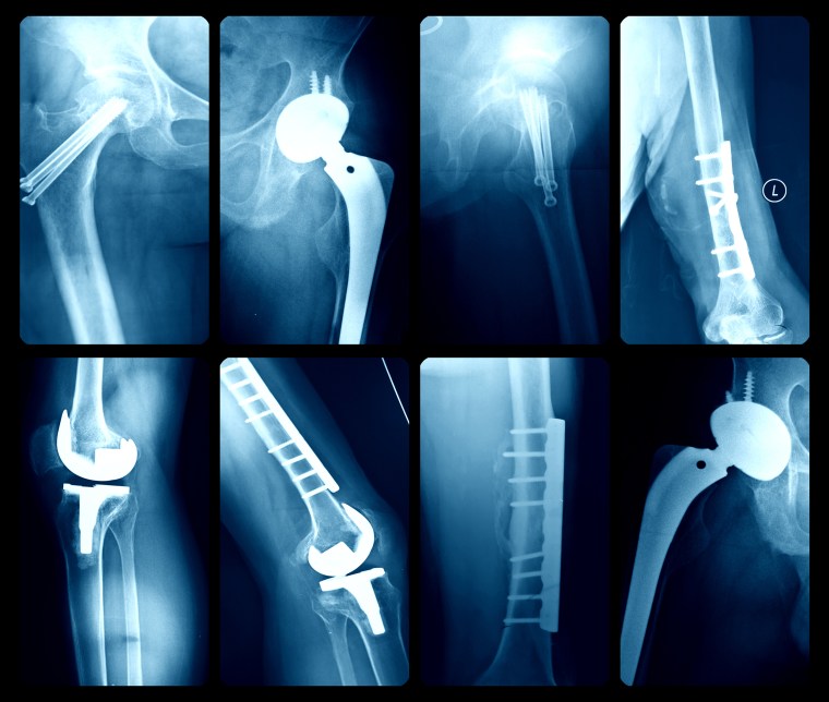 X-ray illustration of artificial joints