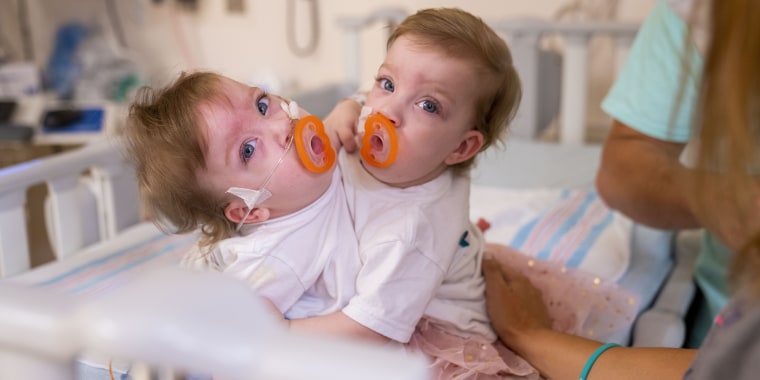 Sarabeth and Amelia Irwin before their separation surgery.