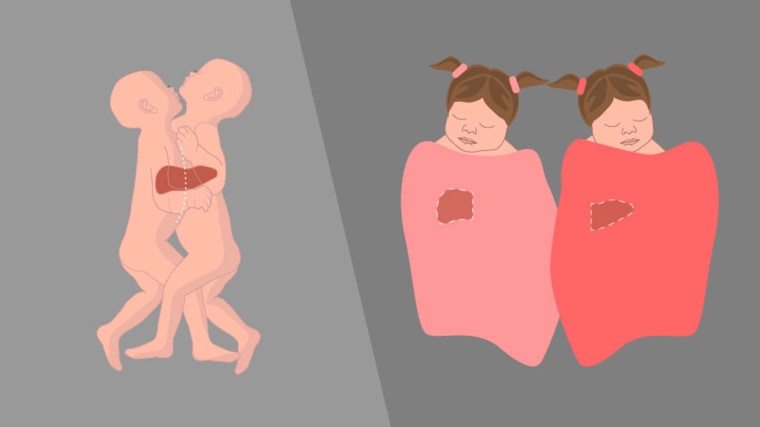 A diagram illustrates how Sarabeth and Amelia were conjoined and separated. 
