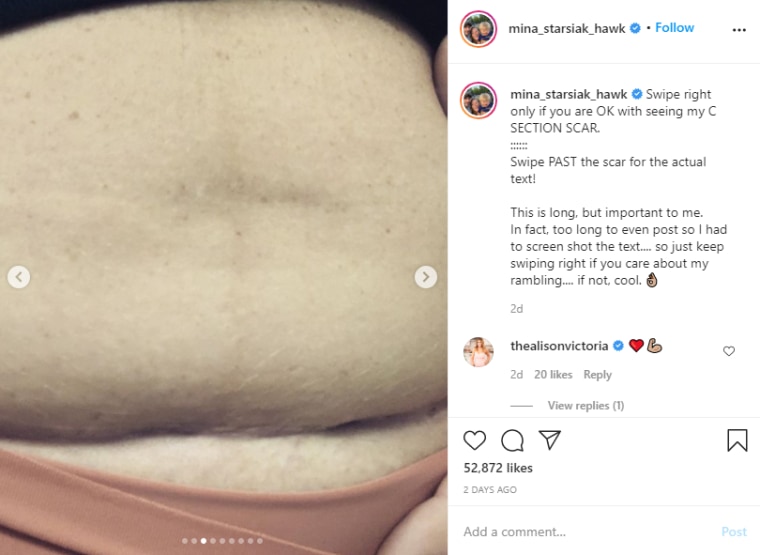 Mina Starsiak Hawk shared this photo of her post-C-section abdomen on Instagram.