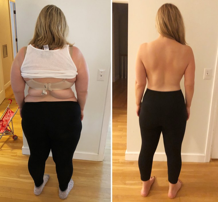 Gastric Sleeve Results After 1 Month - Clear Expectations