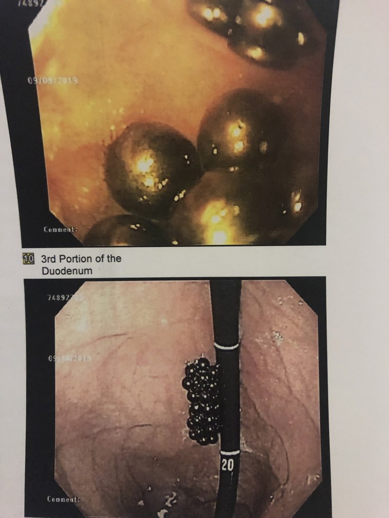 For one scary moment, doctors couldn't see the magnets in Peyton's stomach and thought they had slipped back into his small intestine. They pulled the camera back and realized they were stuck to the scope but still in the stomach. 