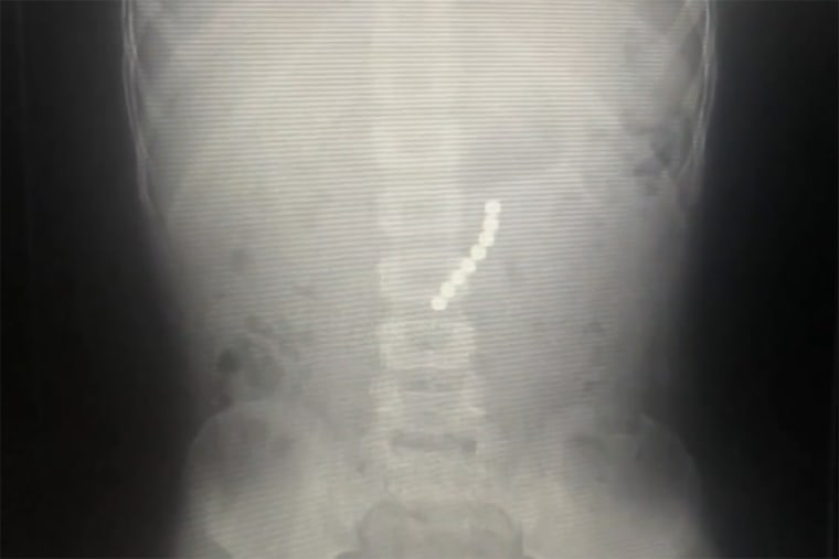 An x-ray shows toy magnets lodged inside 6-year-old Cameron Moreau who was hospitalized after eating them.