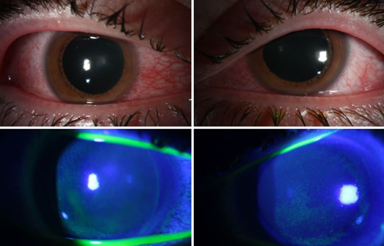 Image: inflammation of the cornea