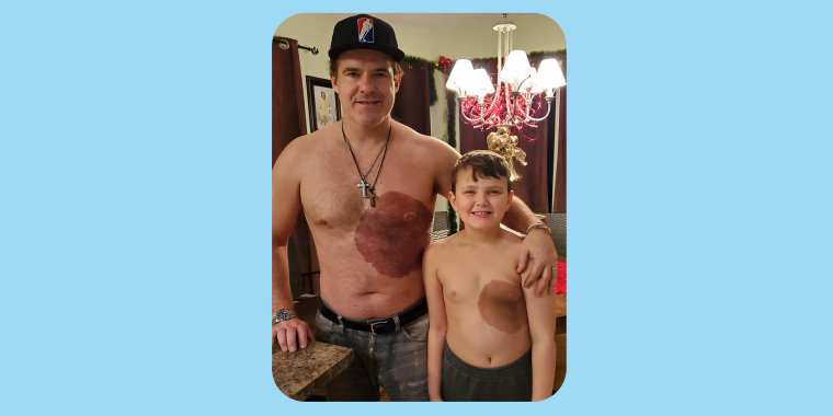 Supportive dad Derek Prue got a tattoo on his torso similar to the birthmark that his 8-year-old son has.