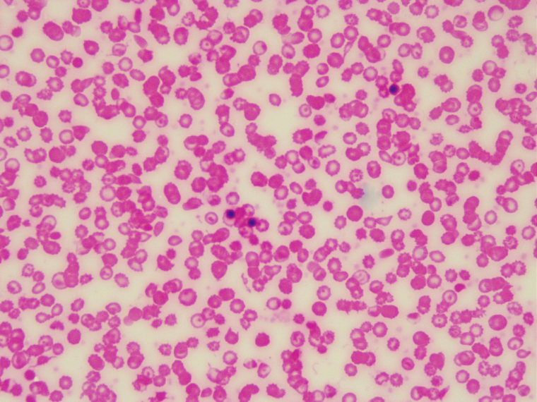 Image: Sickle cell anemia red blood cells under microscope